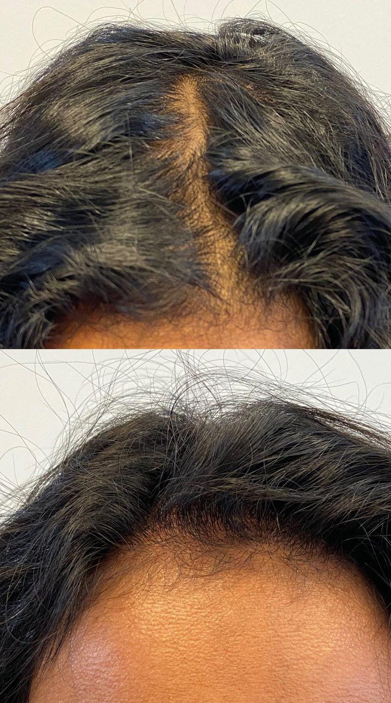 Vrouw-haar-pigmentatie-drenthe-assen