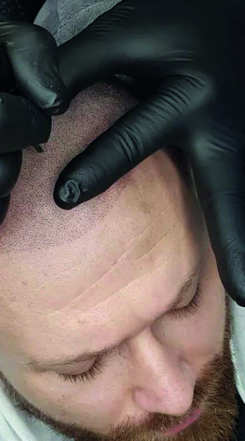 Micro Haar Pigmentatie Drenthe Assen